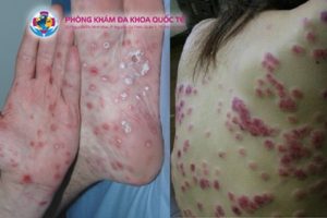 Nguyên nhân mắc giang mai ở nữ giới