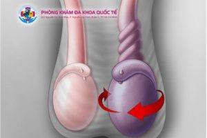 Nguy hiểm khi mắc xoắn tinh hoàn
