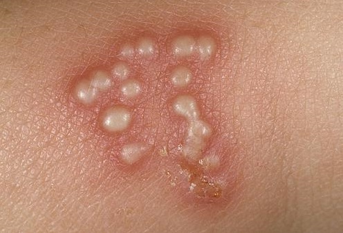 Herpes sinh dục nữ