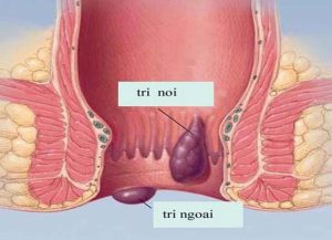 Có 3 dạng bệnh trĩ thường gặp là: