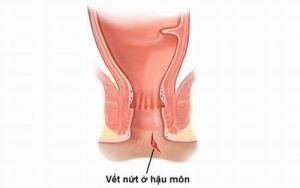 Vết nứt hậu môn