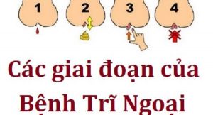 Nhận biết triệu chứng bệnh trĩ bằng cách nào?