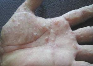 Triệu chứng bệnh tổ đỉa ở tay