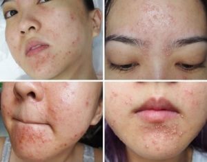 Dị ứng mỹ phẩm bao lâu thì hết?