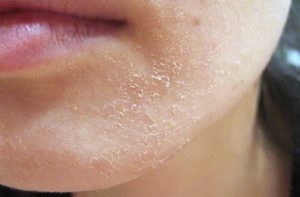 Dấu hiệu dị ứng mỹ phẩm nhẹ