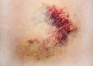 8.Trị đau khớp, chấn thương, tụ máu nhờ cây trinh nữ hoàng cung