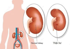 Hội chứng thận hư là gì?