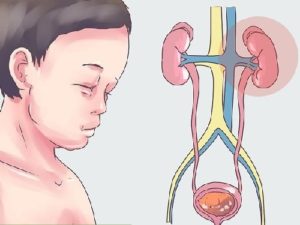 Triệu chứng hội chứng thận hư lâm sàng