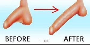 Phẫu thuật kéo dài dương vật là gì?