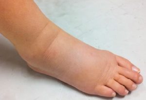 Phù chân khi mang thai là như thế nào?