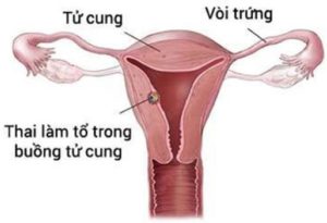 Thai làm tổ trong buồng tử cung – Ra máu và đau bụng khi mang thai tháng đầu