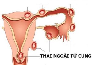 Thai phát triển bên ngoài tử cung