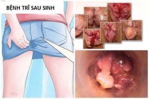 Bệnh trĩ gây ngứa hậu môn