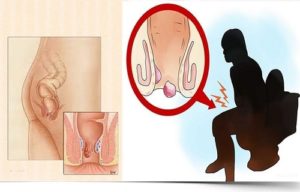 Đau hậu môn sau khi đại tiện