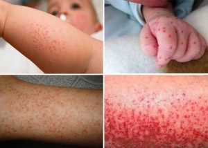 Cách nhận biết sốt siêu vi ở trẻ nhỏ