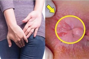 Triệu chứng bệnh trĩ ngoại