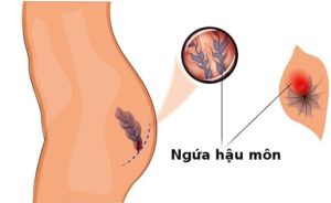 Ngứa hậu môn có gây ra nguy hiểm hay không ?