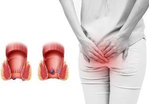 Nguyên nhân gây bệnh trĩ sau sinh