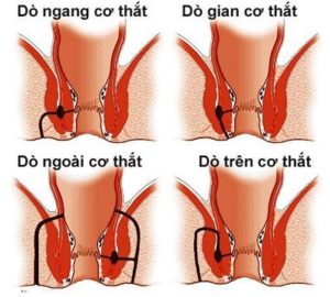 Lỗ rò hậu môn