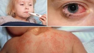 Khám sốt siêu vi cho bé ở đâu TpHCM