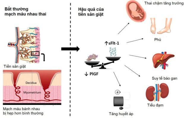 Nguyên nhân của tiền sản giật