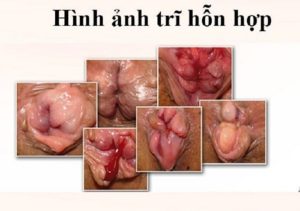 Dấu hiệu bệnh trĩ hỗn hợp không thể bỏ qua