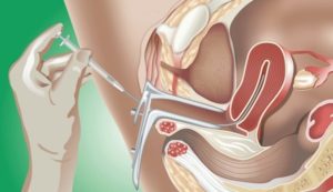 Thụ tinh nhân tạo là gì?